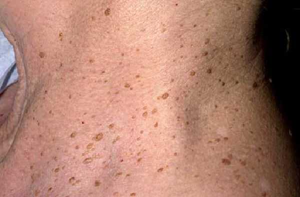 Кератомы на шеее