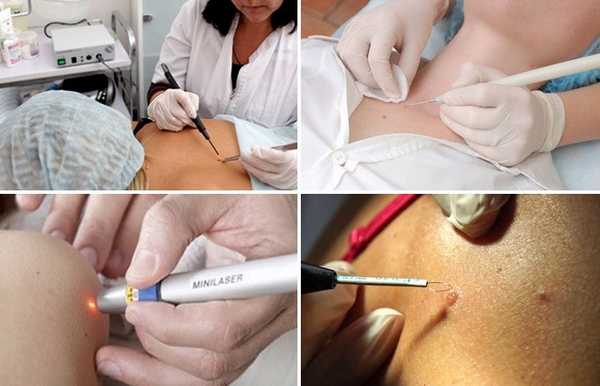 Методики удаления кератом