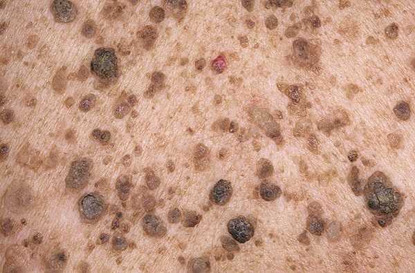 Себорейный кератоз