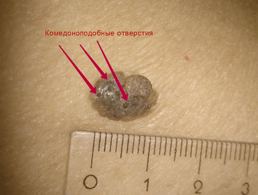 На фото – комедоноподобные отверстия кератомы