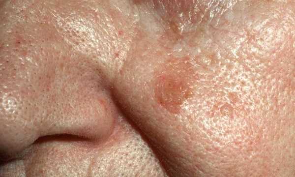 На фото – себорейный кератоз (кератома)