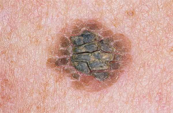 Кератома подлежит удалению