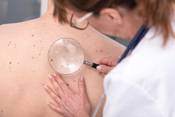 Возникновение кератопапиллом