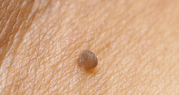 На фото – себорейный кератоз на ножке