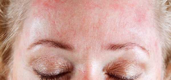 Как выглядит себорейный кератоз