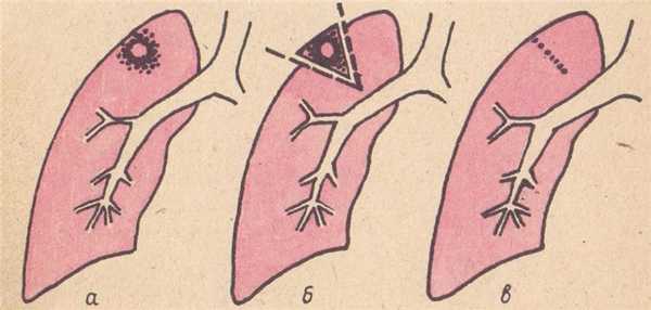 Сегментарная резекция легкого
