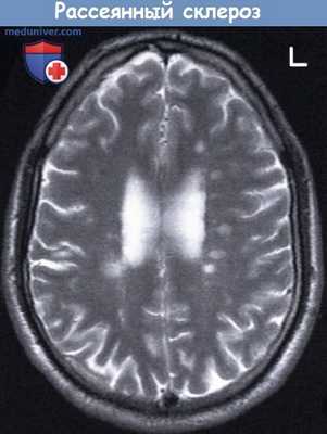Рассеянный склероз