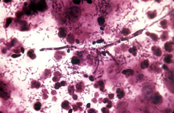 Половые инфекции