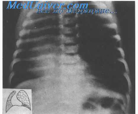 секвестрация легких