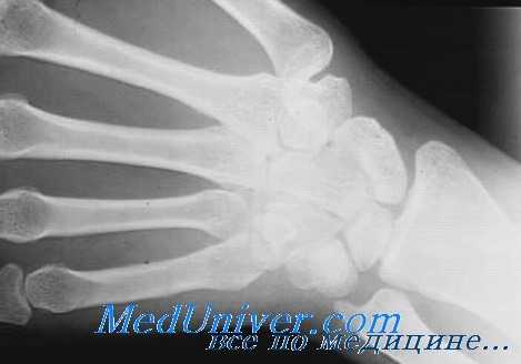 деструкция кости