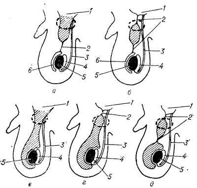 Рис. 3. Схематическое изображение различных видов водянки оболочек семенного канатика и яичка (водяночные полости заштрихованы): а— водянка оболочек семенного канатика, сообщающаяся с полостью брюшины; б— изолированная водянка оболочек семенного канатика; в, г и д — водянка оболочек семенного канатика в сочетании с водянкой оболочек яичка (в — водяночные полости сообщаются между собой и с полостью брюшины; г — водяночные полости сообщаются только между собой; д — водяночные полости изолированы); 1 — полость брюшины; 2 — облитерированная часть влагалищного отростка брюшины; 3 — семявынорящий проток; 4 — придаток яичка; 5 — яичко; 6 — оболочки яичка. Пунктирной линией окружены анатомические образования, входящие в состав семенного канатика.