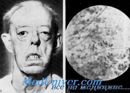 глухота и офтальмоплегия