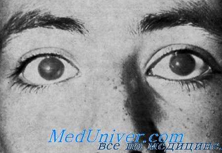 синдром харбойяна