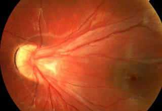 Экссудативная семейная витреоретинопатия