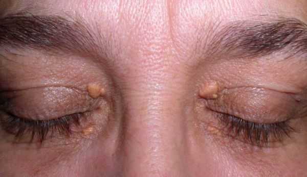 Ксантелазмы век