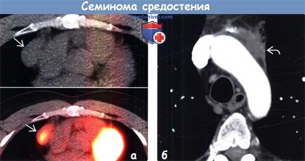 Семинома средостения на КТ, ПЭТ