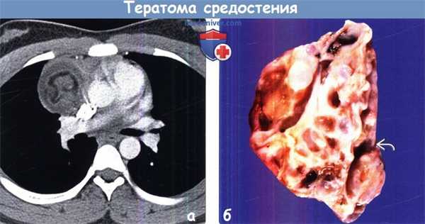 Тератома средостения на КТ, гистологии