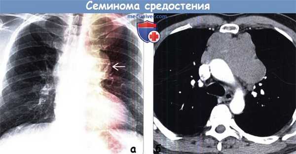 Семинома средостения на рентгенограмме, КТ