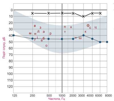 Рисунок 3. Пороговая тональная аудиограмма при поражении звукопроводящего аппарата. Пороги слышимости костнопроведенных тонов не нарушены. Пороги слышимости воздушнопроведенных звуков до 40 - 50 дБ. Между порогами слышимости костно- и воздушнопроведенных звуков имеется существенная разница - костновоздушный интервал. Условные обозначения: х - пороги слышимости костнопроведенных звуков, - пороги слышимости воздушнопроведенных звуков.