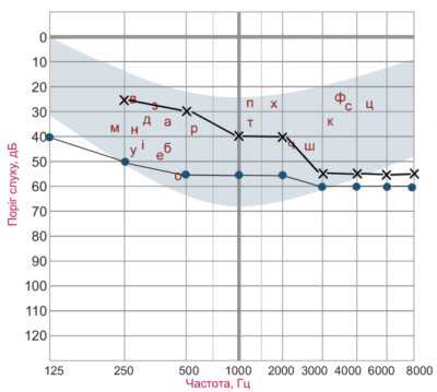 Рисунок 7. Тональная пороговая аудиограмма при комбинированной тугоухости. Пороги слышимости костно- и воздушнопроведенных тонов нарушены в разной степени. Пороги слышимости костно-проведенных тонов в диапазоне частот 250 - 2000 Гц ниже чем в норме, но выше чем пороги слышимости воздушно-проведенных звуков. В этом частотном диапазоне имеется костно-воздушный интервал. Условные обозначения те же, что и на рисунке 3.