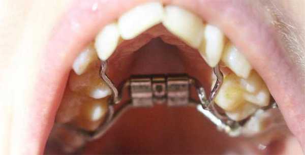 аппарат дерихсвайлера инструкция