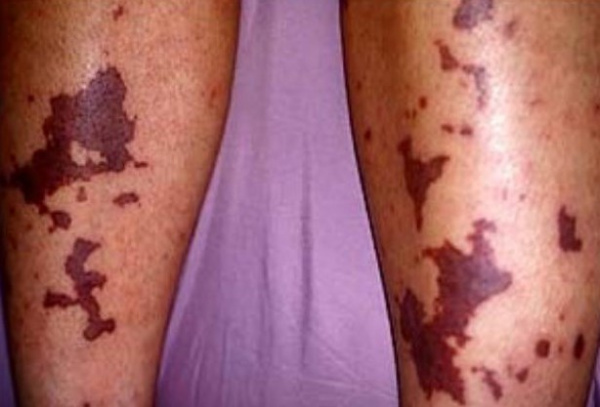 Геморрагические элементы на коже при ДВС-синдроме
