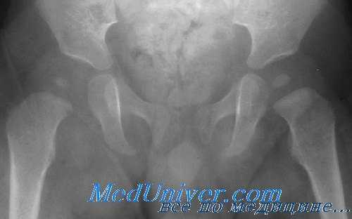 септический артрит тазобедренного сустава