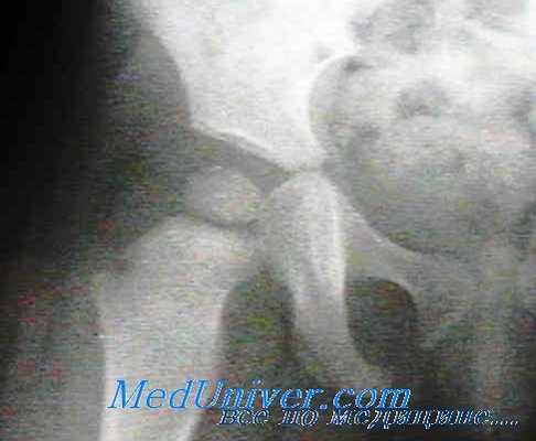 септический артрит тазобедренного сустава