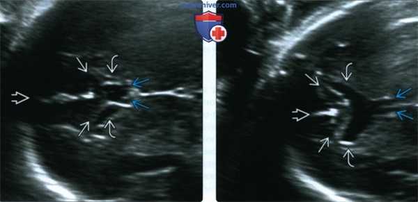 УЗИ, МРТ при септооптической дисплазии (СОД) у плода