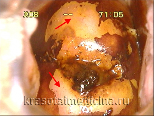 Септооптическая дисплазия