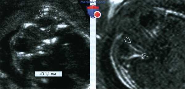 УЗИ, МРТ при септооптической дисплазии (СОД) у плода