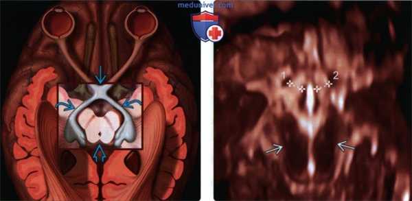 УЗИ, МРТ при септооптической дисплазии (СОД) у плода