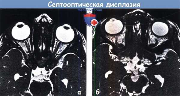 Септооптическая дисплазия (синдром де Морсье) на МРТ