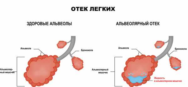 Отек легких.jpg