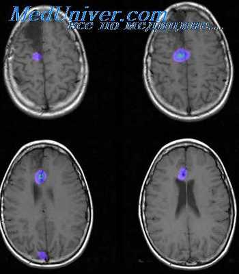 эпилептический очаг