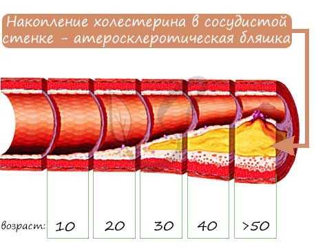 Атеросклероз