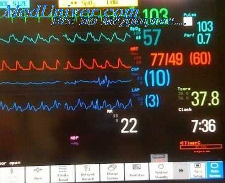 сердечный выброс