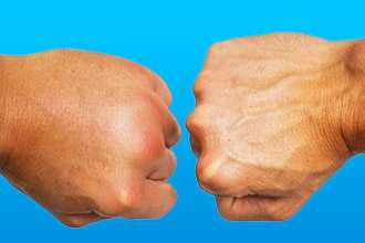 Периферические отеки