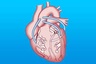 Аортокоронарное шунтирование