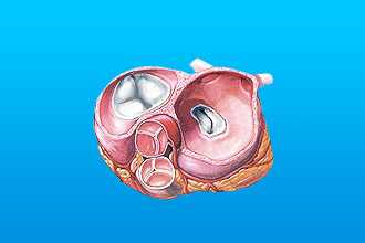 Митральные стеноз