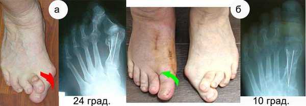 Рафикова пронация супинация.jpg