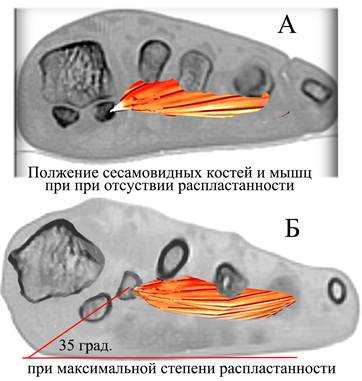 плоскостоп мышцы подошвы СКТ 3