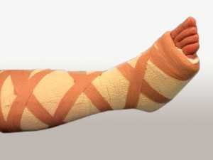 гипс на ноге