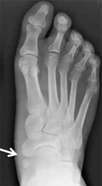 1 тип добавочной ладьевидной кости