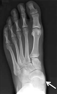 2 тип добавочной ладьевидной кости