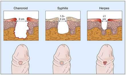 Отличие мягкого шанкра от сифилиса и герписа