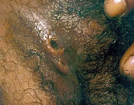 Свищ поражённого пахового лимфоузла