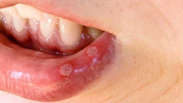 Твёрдый шанкр от сифилиса