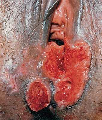 Серповидный шанкр