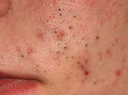 Комедональная форма акне